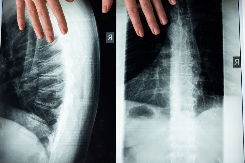 spinal xray